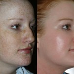 b&a-glycolic peel